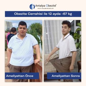obesity_surgery_before_after__0012_17